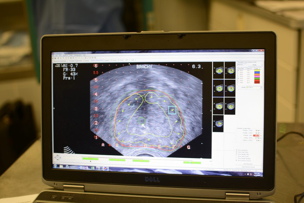 Real time Strahlenplanung in der Prostata bei Brachytherapie 